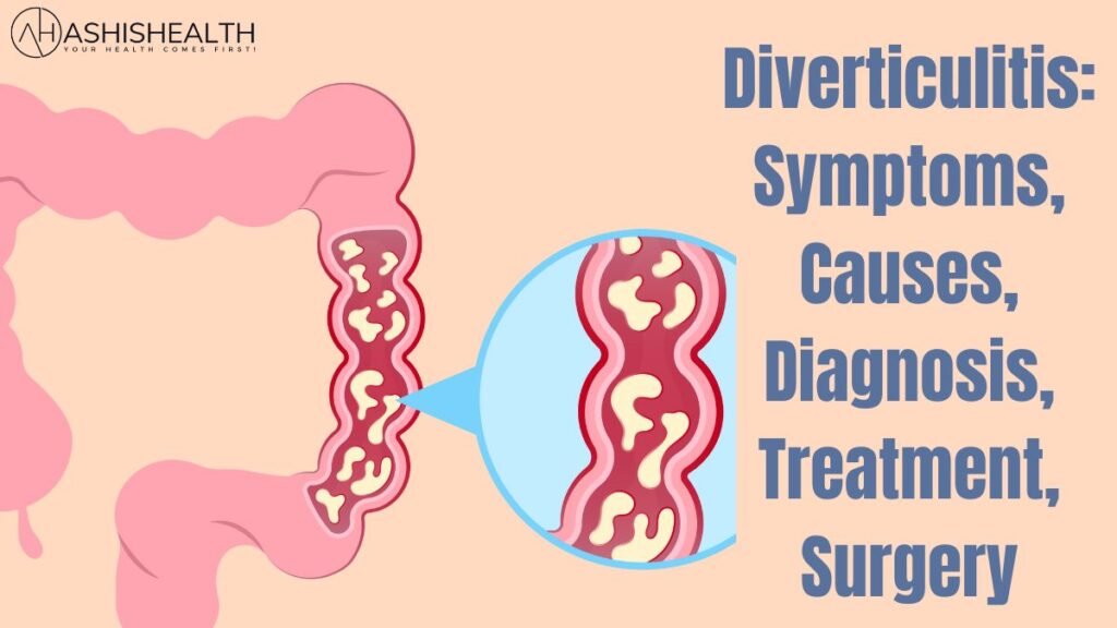 Diverticulitis Symptoms, Causes, Diagnosis, Treatment, Surgery