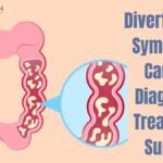 Diverticulitis: Symptoms, Causes, Diagnosis, Treatment, Surgery Diverticulitis: Symptoms, Causes, Diagnosis, Treatment, Surgery