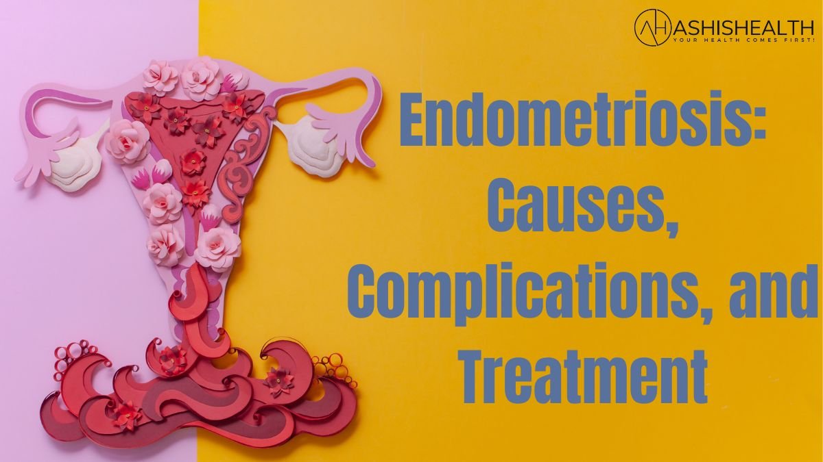 Endometriosis: Causes, Complications, and Treatment