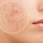 What is Acne? What is Acne?